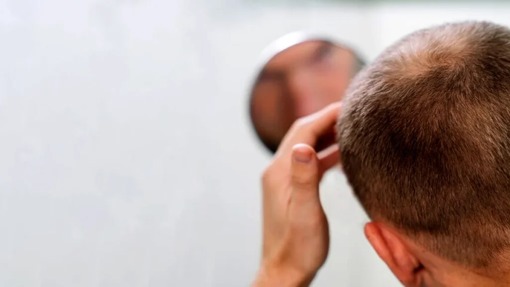 Say Goodbye To Hair Loss With These 6 Natural Remedies 