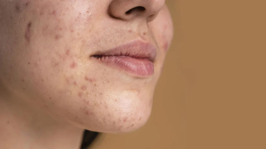 A Comprehensive Guide to Acne Scars: Causes, Symptoms, and Treatment 