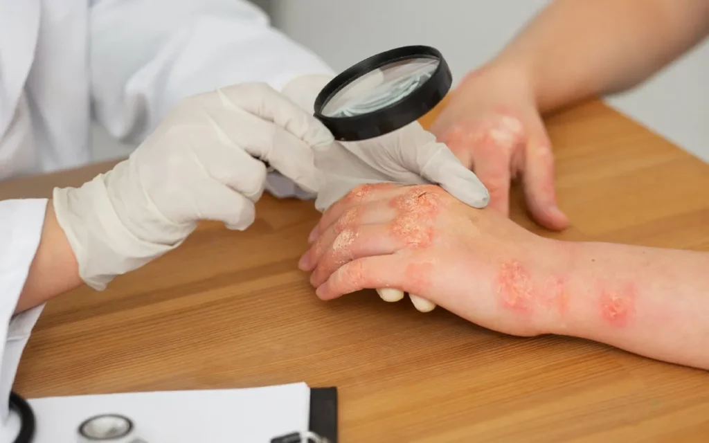 How to treat and prevent fungal infections in the skin