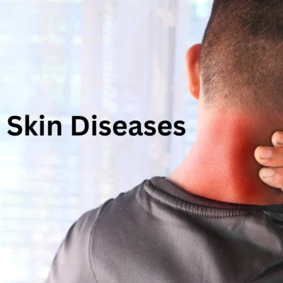 Common Skin Disease​
